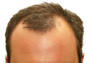 Receding hairline treatment with hair transplants - causes and cure of mature hairline